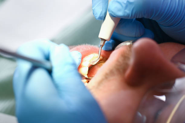 Best Dental Abscess Treatment in Wolverine Lake, MI
