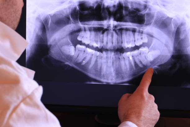 Best Knocked-Out Tooth (Avulsed Tooth) Treatment in Wolverine Lake, MI